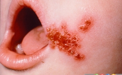 عفونت پوستی در کودکان