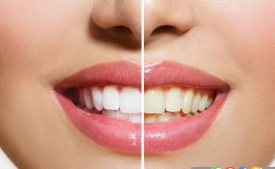 عوامل موثر بر تغییر رنگ دندان ها