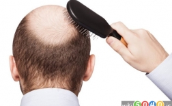راه های موثر متوقف کردن ریزش مو در مردان
