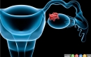 درمان های خانگی مفید برای سرطان تخمدان 2