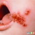 عفونت پوستی در کودکان