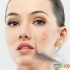 انواع روش های درمان لک های پوستی