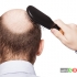 راه های موثر متوقف کردن ریزش مو در مردان
