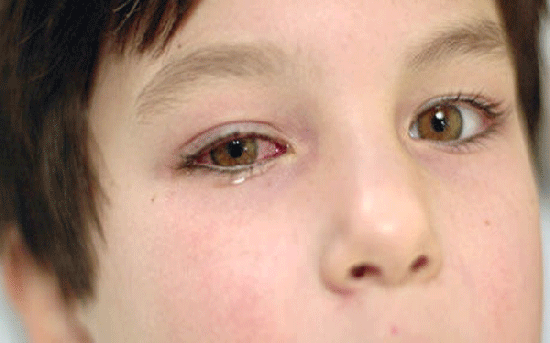 چشم صورتی: نشانه‌ها، دلایل ایجاد، و روش‌های درمان چشم صورتی