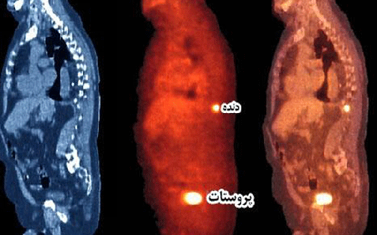راهنمای تصویری سرطان پروستات 