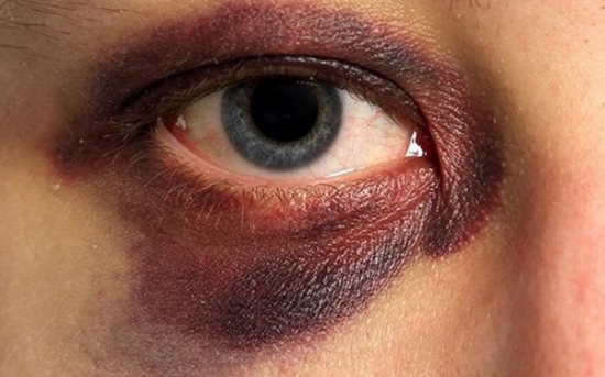 کمک‌های اولیه در کبودی چشم 