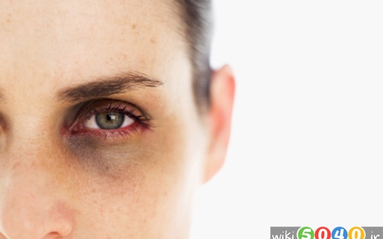درمان های خانگی برای حلقه های سیاه زیر چشم